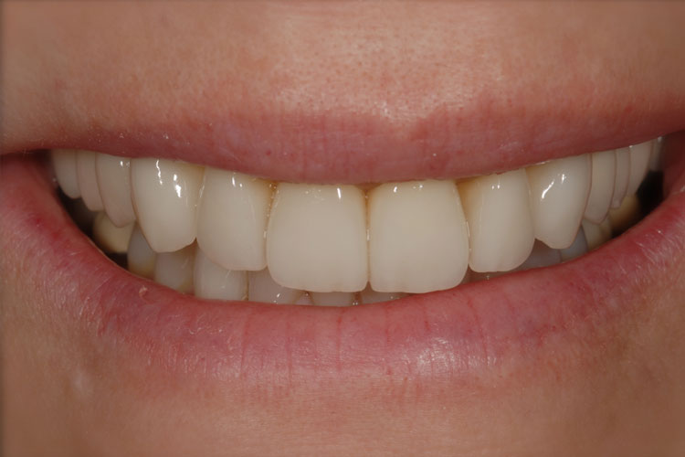 Esthetic Crowns after