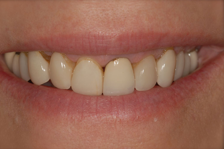 Esthetic Crowns before