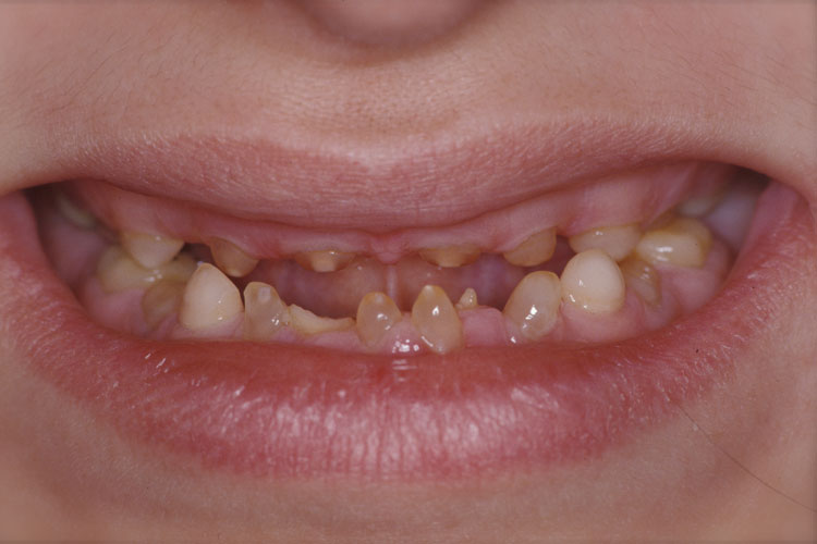 Implant Full Mouth Reconstruction before