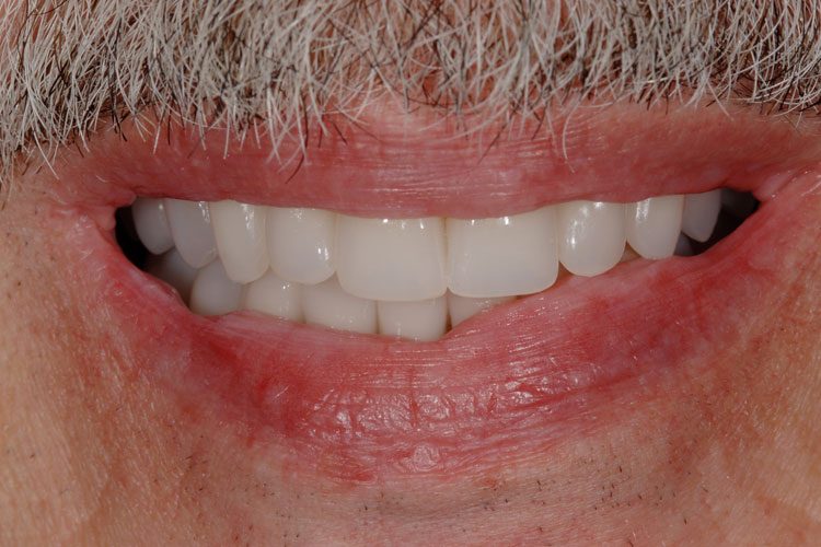 All-on-4 Implant Bridge after