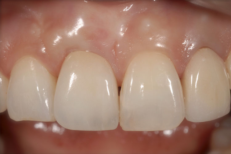 Implant Crown after