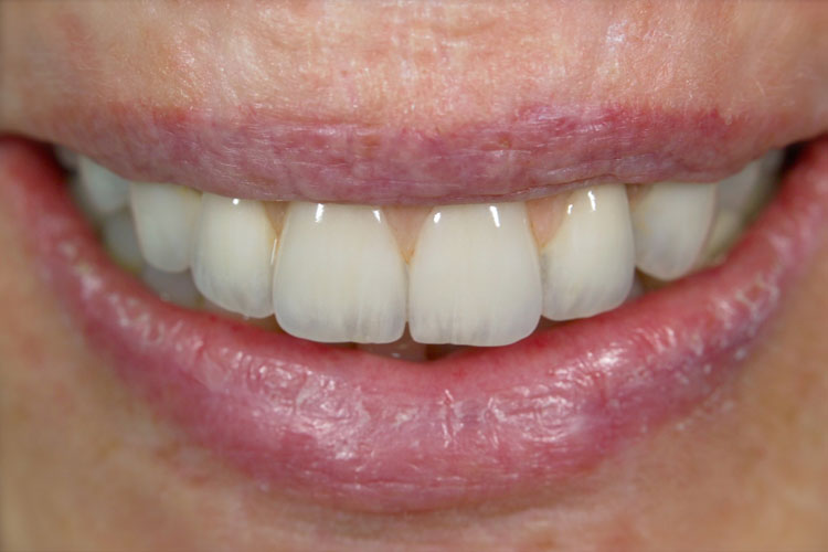 Implant Full Mouth Reconstruction after